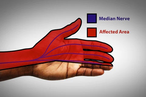 Confronting Hand Grip Weakness: Causes, Diagnosis, and Effective Solutions